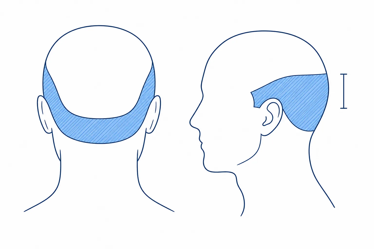 Illustration of the head from behind and in profile with the safe donor area on the horseshoe rim highlighted