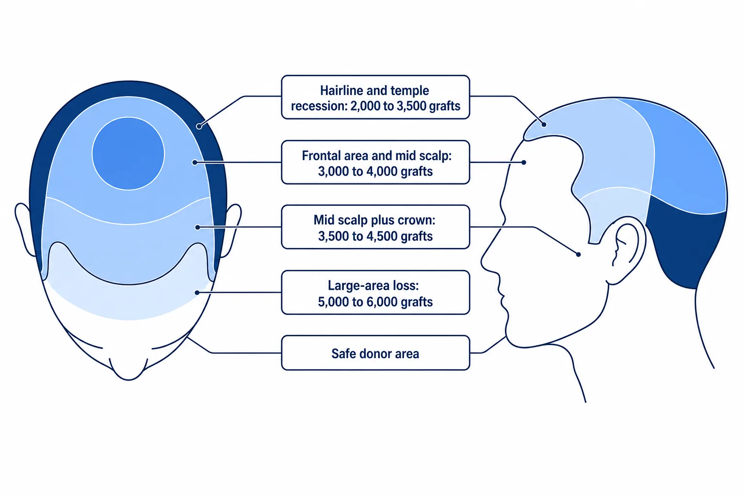 Diagram of a head from above and in profile with color-coded zones and the matching graft ranges