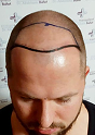 Elithair'deki saç ekiminden önce Nico