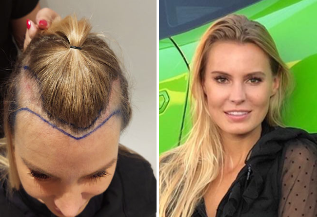 دورين س. — زراعة الشعر للنساء 3,100 بصيلة