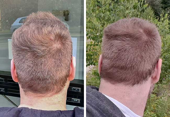 Zone donneuse après greffe capillaire avant-après – Kewin L., 4 500 greffons, 8 mois après l'intervention