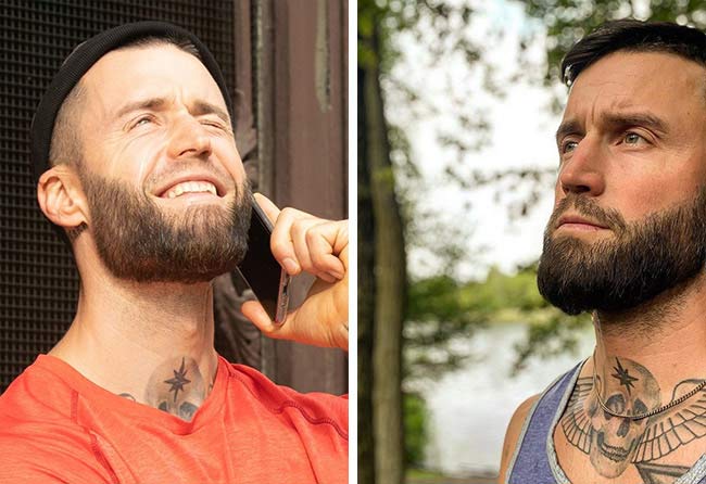 Résultat de greffe de barbe Jhaki &ndash; 4 200 greffons, direction de pousse naturelle grâce au DHI