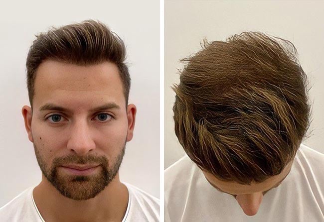 Résultat à long terme d'une greffe de cheveux : Marcel O., 4 200 greffons, densité complète