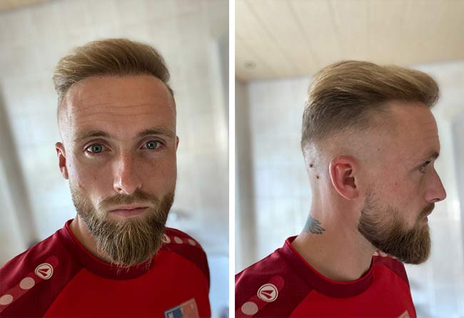 Résultat final greffe de cheveux à 12 mois : Frederik G., 4 700 greffons