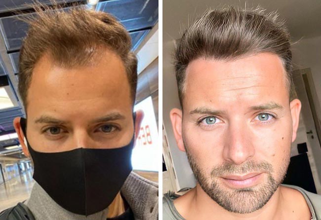 Sommet du crâne à 12 mois avant-après : Marcel O., 4 200 greffons