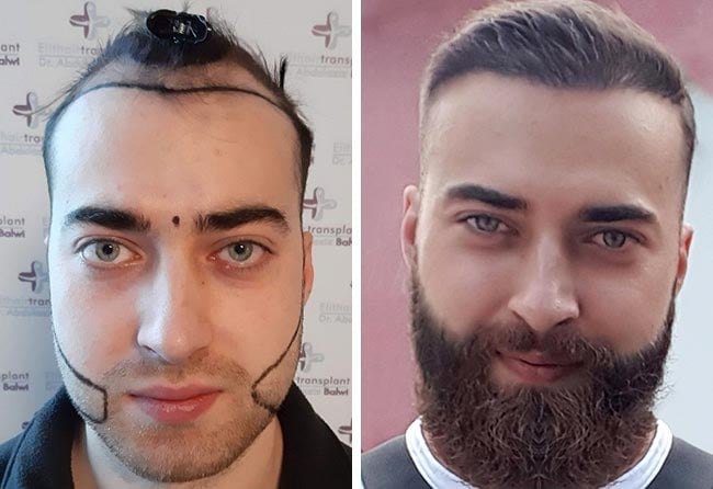 Greffe de barbe avant-après Andre U., 4 250 greffons Saphir