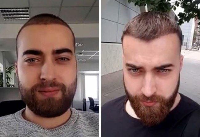 Cicatrisation de greffe de barbe à 4 mois : Andre U., 4 250 greffons