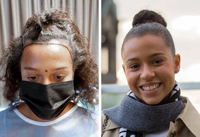 Greffe de cheveux femme avant-après Melissa Z. &ndash; 2 700 greffons Saphir FUE