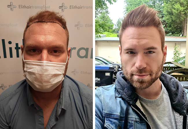 Greffe de cheveux à 12 mois avant-après : Kewin L., 4 500 greffons