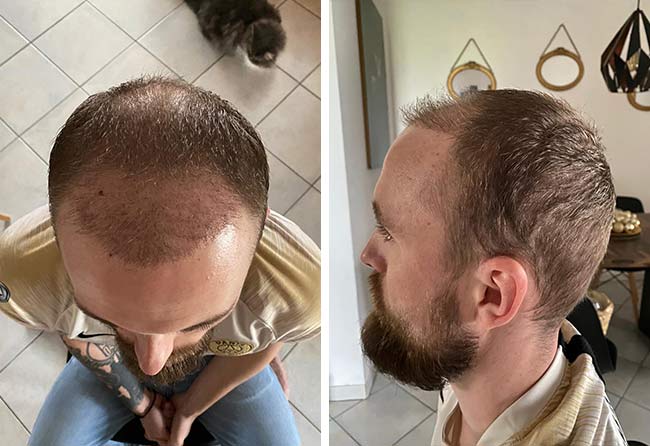 Greffe de cheveux à 2 mois : Frederik G., pousse précoce