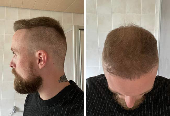 Greffe de cheveux à 6 mois : Frederik G., pousse marquée
