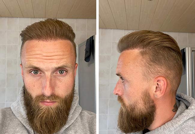 Greffe de cheveux à 8 mois : Frederik G., pleine densité visible