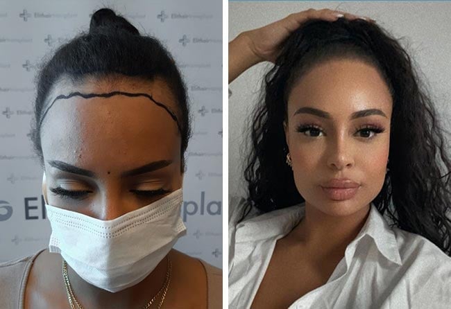 Greffe de cheveux femme avant-après Jahy C. &ndash; 3 200 greffons SDHI