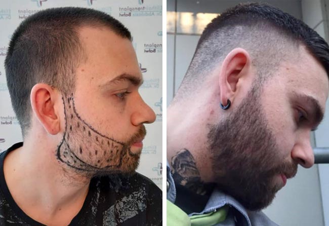Greffe de barbe avant-après Nico M., 2 700 greffons Saphir