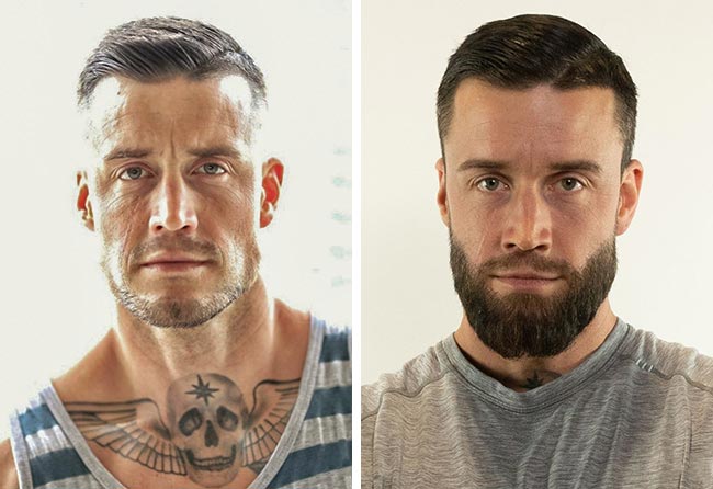 Greffe de barbe avant-après Jhaki, 4 200 greffons Saphir