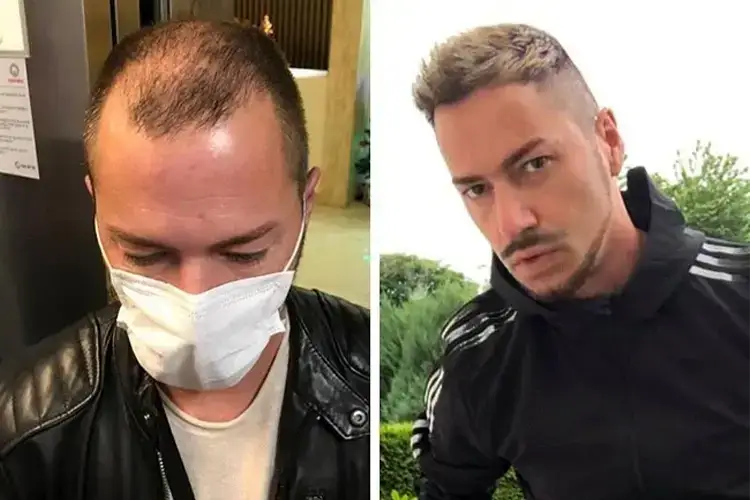 Greffe de cheveux sur le vertex avant-après, Andre O., 5 200 greffons DHI chez Elithair