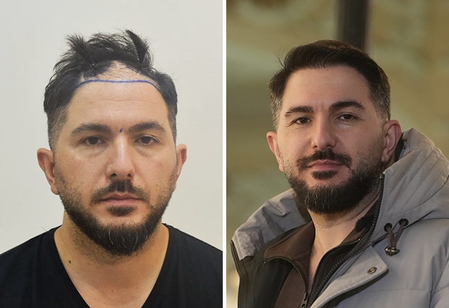 Résultat final à 18 mois : Onur Y., 4 200 greffons DHI